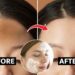 How to Remove Forehead Tan